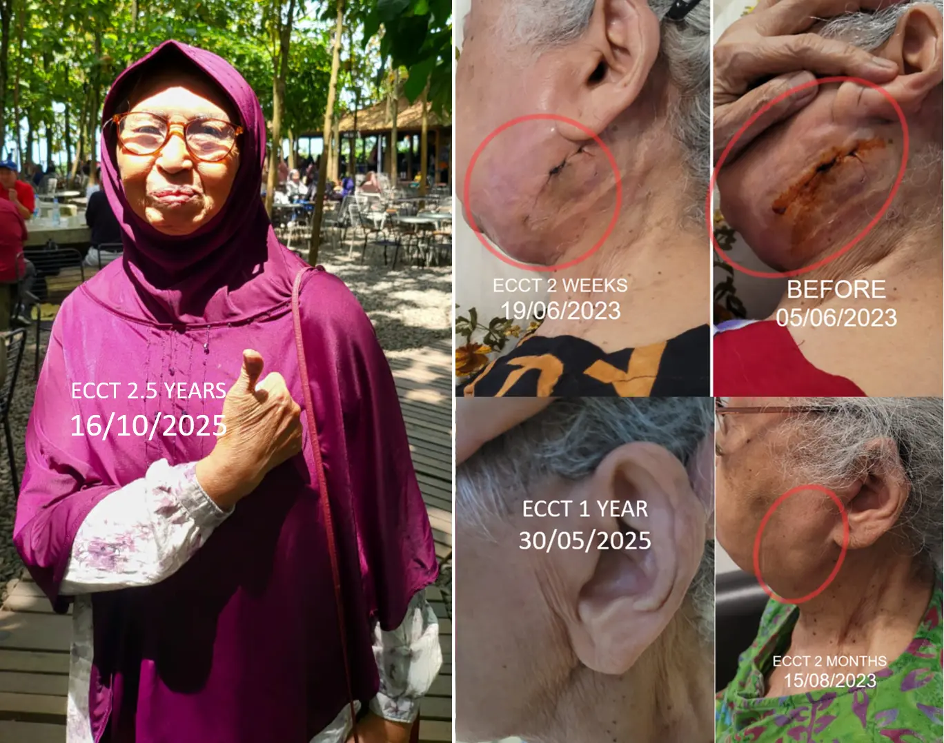 80-Year-Old Faces Lymphoma Cancer